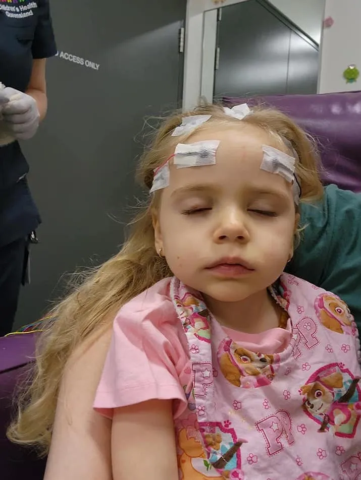 A child with STXBP1 wearing EEG electrodes.